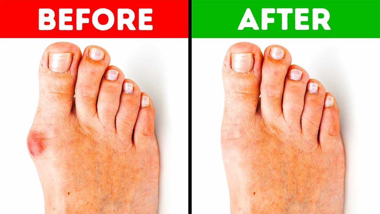 How to Shrink Bunions Naturally